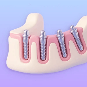 3D illustration of angled implants making better use of available bone.