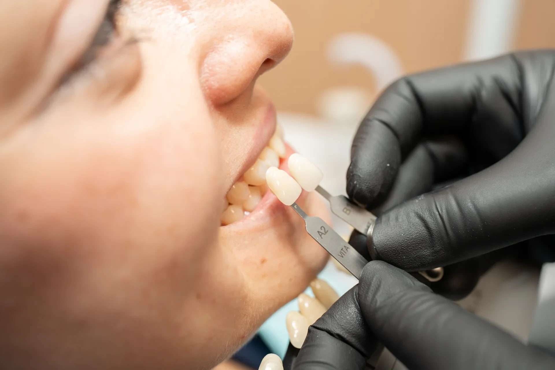 Comparación de muestras de tono junto a los dientes de una paciente durante la planeación de una corona.