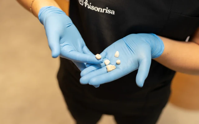 A hisonrisa dental professional holding several tooth-colored restorations in blue gloves.