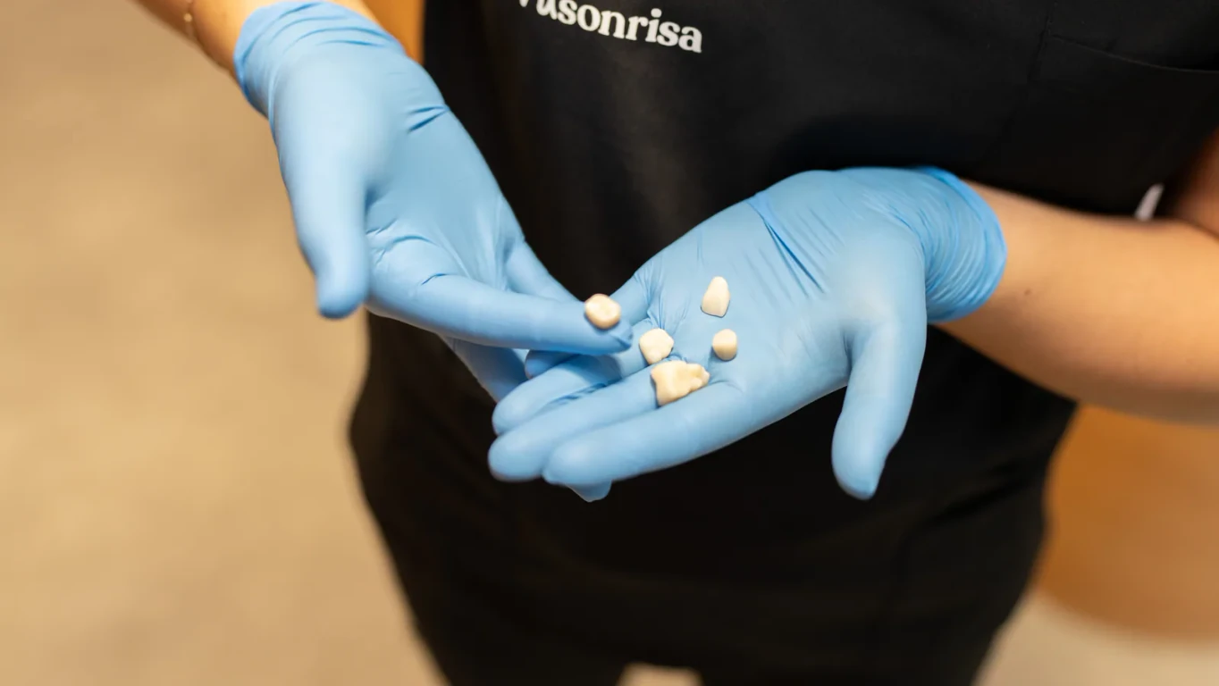 A hisonrisa dental professional holding several tooth-colored restorations in blue gloves.