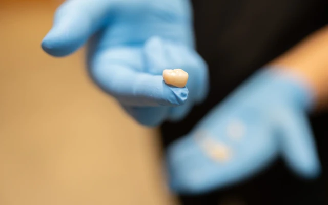 Corona dental sobre un guante azul durante la selección del material para una restauración.
