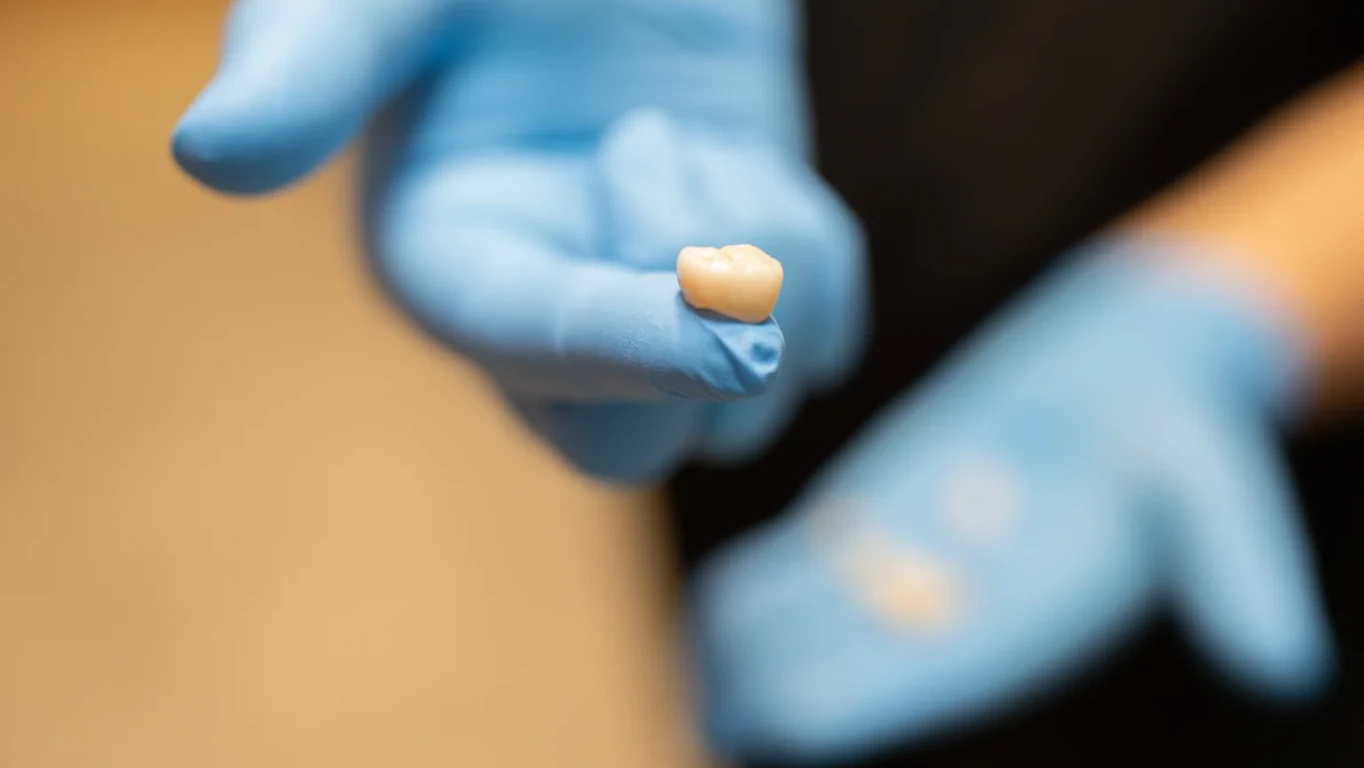 Corona dental sobre un guante azul durante la selección del material para una restauración.