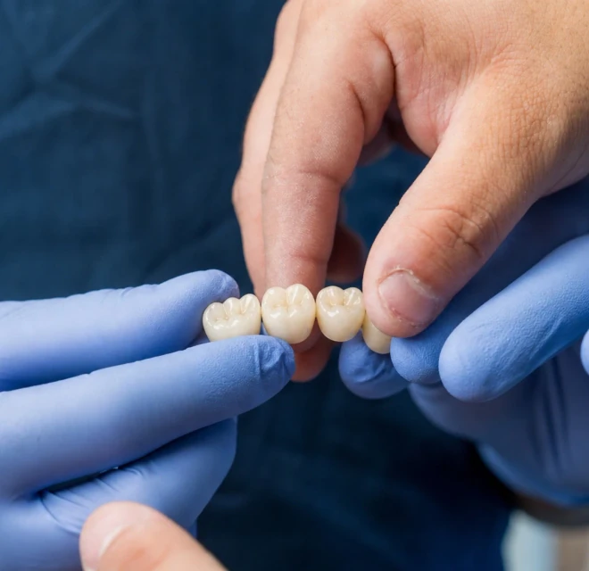 Gloved hands holding a ceramic dental bridge during restorative planning at hisonrisa in Roma Sur, Mexico City.