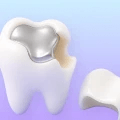 Large filling and weakened tooth icon for crown evaluation.