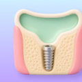 Upper jaw bone volume and sinus anatomy for implant planning.