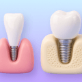 3D icon comparing front-tooth and molar implant planning.