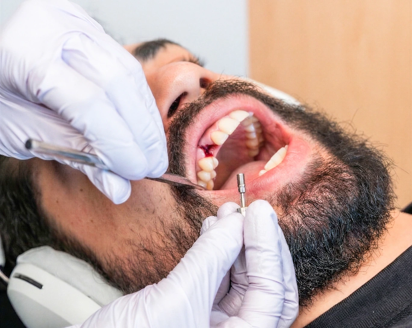 Single dental implant placement at hisonrisa in Roma Sur, Mexico City.