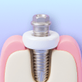 Bone graft planning for a dental implant.