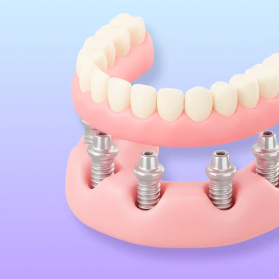 Go to all-on-4 treatment page