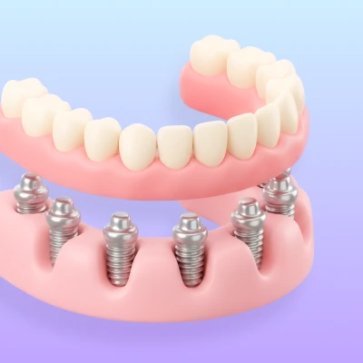 Go to all-on-6 treatment page