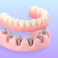 All-on-6 icon with a full-arch implant bridge.
