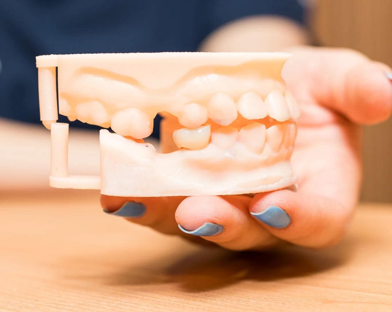 Dental model used to explain an inlay or onlay restoration at hisonrisa in Roma Sur, Mexico City.
