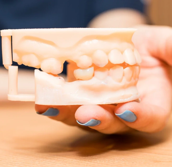 Hands holding a dental model with a molar restoration space for inlay or onlay planning in Mexico City.