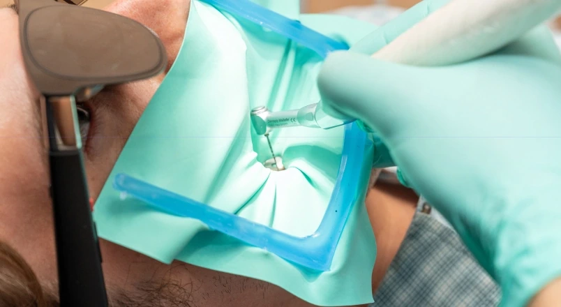 Root canal treatment with isolation during final-restoration planning at hisonrisa in Mexico City.